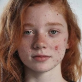 Best Dermatologist in Gurgaon for Teenage Acne Problem
