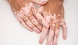 Best Dermatologist in Gurgaon for Vitiligo Treatment Problem