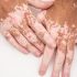 Best Female Dermatologist in Gurgaon for Hormonal Acne Problem