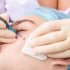 Best Skin Care Routine After Q Switch Laser Treatment