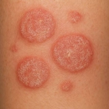 Best Remedy for Adults for Nummular Eczema Problem