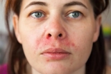 Best Remedy for Adults for Seborrheic Dermatitis on Face Problem