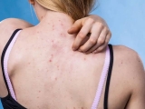 Best Remedy for Teenagers for Fungal Acne Problem