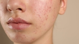 Best Remedy for Teenagers for Steroid Induced Acne Problem