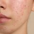 Best Skin Care for Adults for Dermatographia Problem: A Gentle Guide to Calm Your Skin
