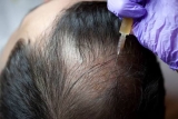 Best Skin Care After PRP Treatment for Hair Fall Problem