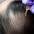Best Skin Recovery Routine After Microneedling Treatment Problem