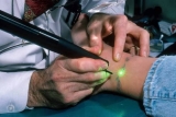 Best Skin Care After Tattoo Removal Laser Treatment Problem