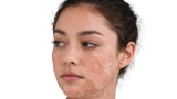 Best Skin Care Routine After Chemical Peel Treatment Problem