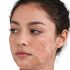 Best Remedy for Teenagers for Steroid Induced Acne Problem