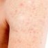 Best Dermatologist Advice for Sebaceous Hyperplasia