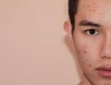 Best Skin Clinic in Gurgaon for Men’s Skincare Problem