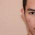 Best Dermatologist in Gurgaon for Teenage Acne Problem