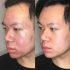 Best Treatment for Women for HydraFacial for Dull Skin Problem