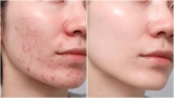 Best Skin Recovery Tips After Acne Scar Laser Treatment Problem