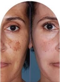 Best Skin Specialist Near Me in Gurgaon for Melasma Problem