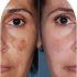 Best Dermatologist in Gurgaon Sector 51 for Acne Scars Problem