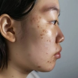 Best Skin Treatment for Adults for Post Inflammatory Hyperpigmentation Problem