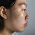 Best Remedy for Teenagers for Fungal Acne Problem