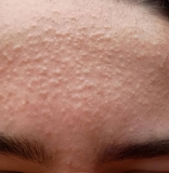 Best Skin Treatment for Teenagers for Closed Comedones