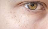 Best Skin Treatment for Teenagers for Milia Bumps Problem