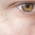 Best Dermatologist Advice for Adults for Keratosis Pilaris Problem