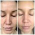 Best Dermatologist for Women for Vampire Facial for Skin Texture Problem