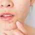 Best Dermatologist Advice for Adults for Keratosis Pilaris Problem