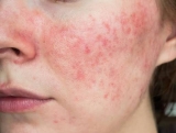 Best Treatment for Adults for Rosacea Flare-Ups Problem