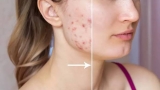 Best Treatment for Teenagers for Salicylic Acid Peel for Acne Problem