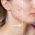 Best Dermatologist for Adults for CO2 Laser for Acne Scars Problem