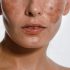Best Dermatologist Solution for Adults for Actinic Keratosis Problem