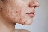 Best Treatment for Women for Hormonal Cystic Acne on Jawline