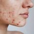 Best Dermatologist Advice for Sebaceous Hyperplasia