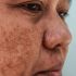 Best Treatment for Teenagers for Salicylic Acid Peel for Acne Problem