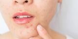 Dr Pretty Singla Review for Acne Treatment in Gurgaon