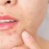 Best Dermatologist for Bridal Skin Prep in Gurgaon