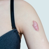 Struggling with a Keloid Scar? Here is How to Find Relief