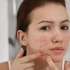 Best Skin Clinic Near Sector 51 Gurgaon for Laser Treatment Problem